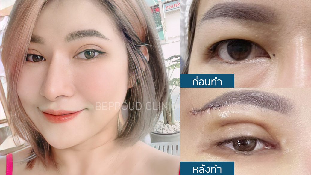 ตาสองชั้นแผลใต้คิ้ว