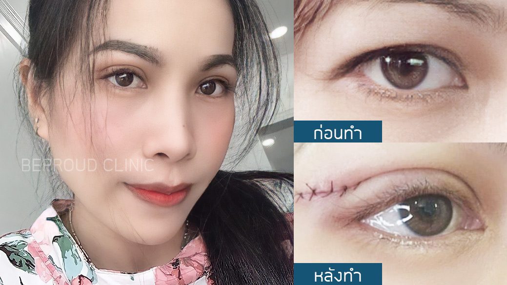 เทคนิค ยกหางหงส์