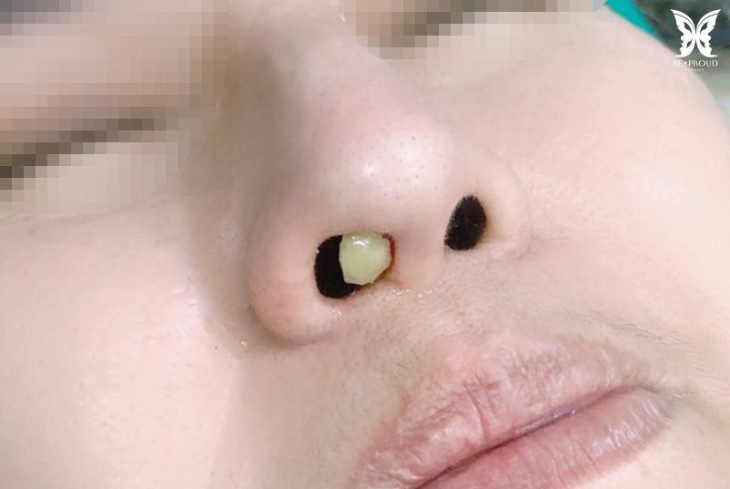 ซิลิโคนทะลุ-2 ซิลิโคนทะลุ-2