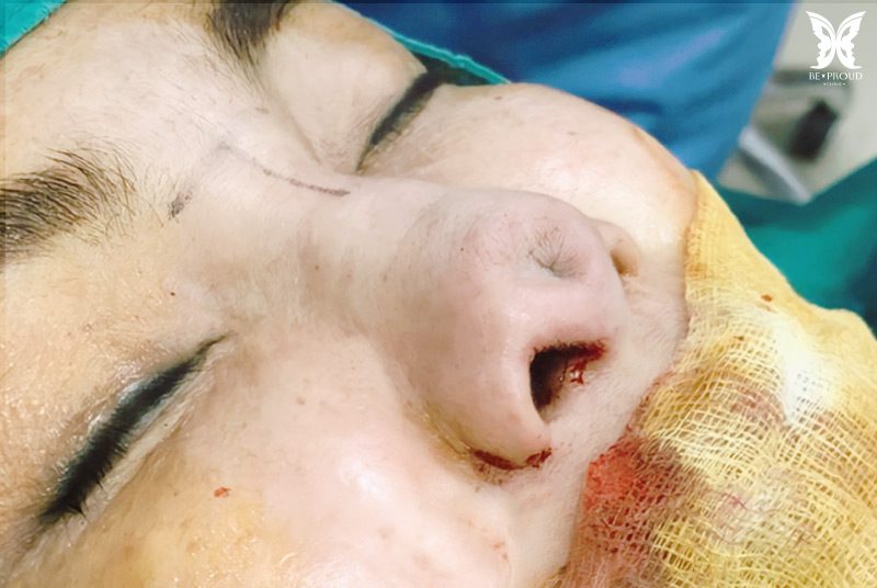 ซิลิโคนทะลุ-3 ซิลิโคนทะลุ-3