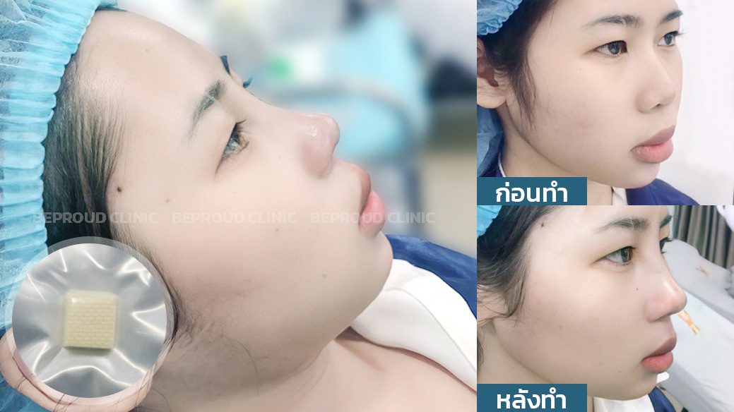 รองปลายเนื้อเยื่อเทียม รองปลายเนื้อเยื่อเทียม