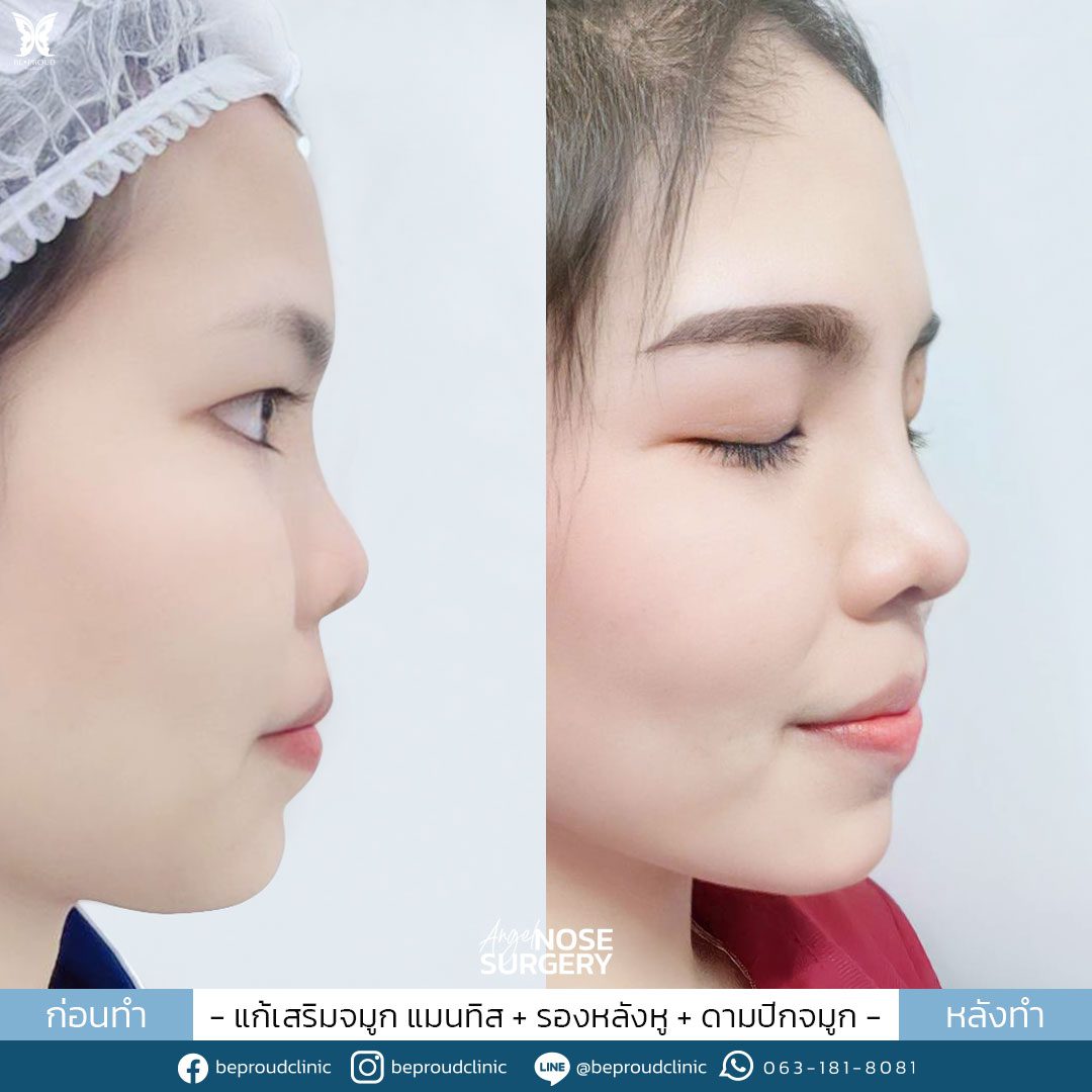 รีวิวจมูก-60 รีวิวจมูก-60