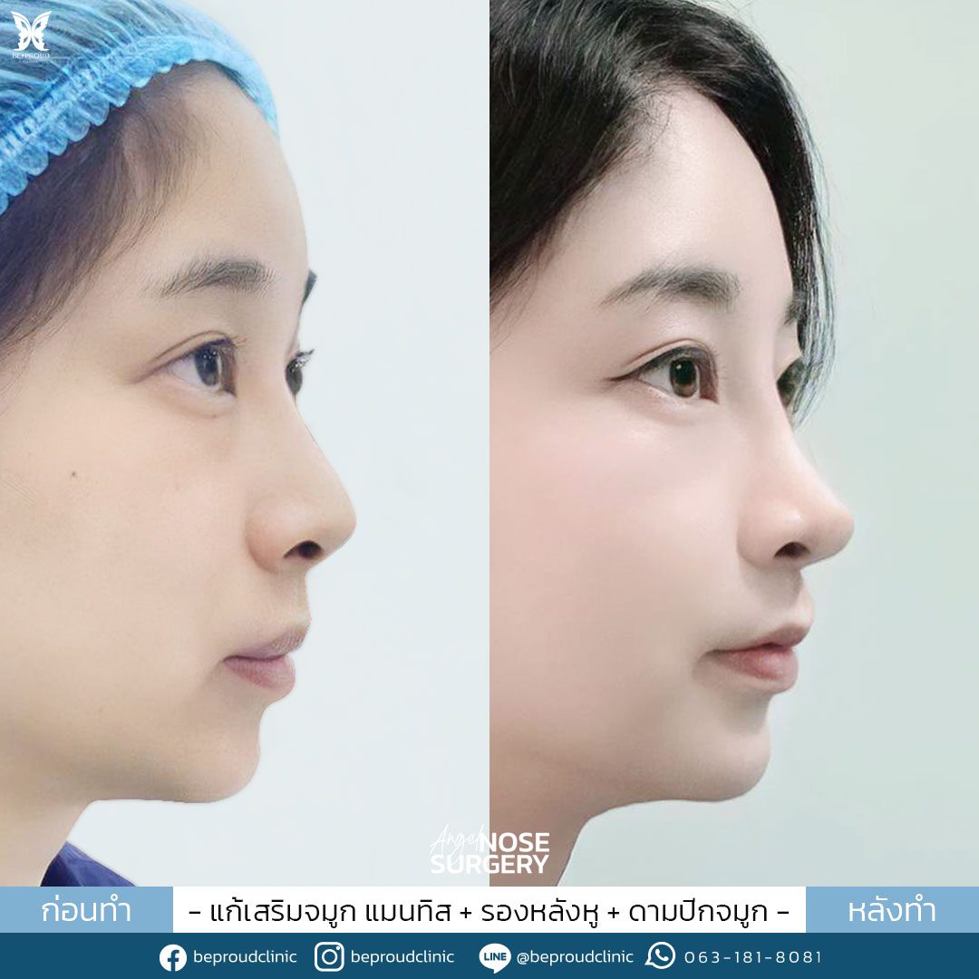 รีวิวจมูก-58-2 รีวิวจมูก-58-2