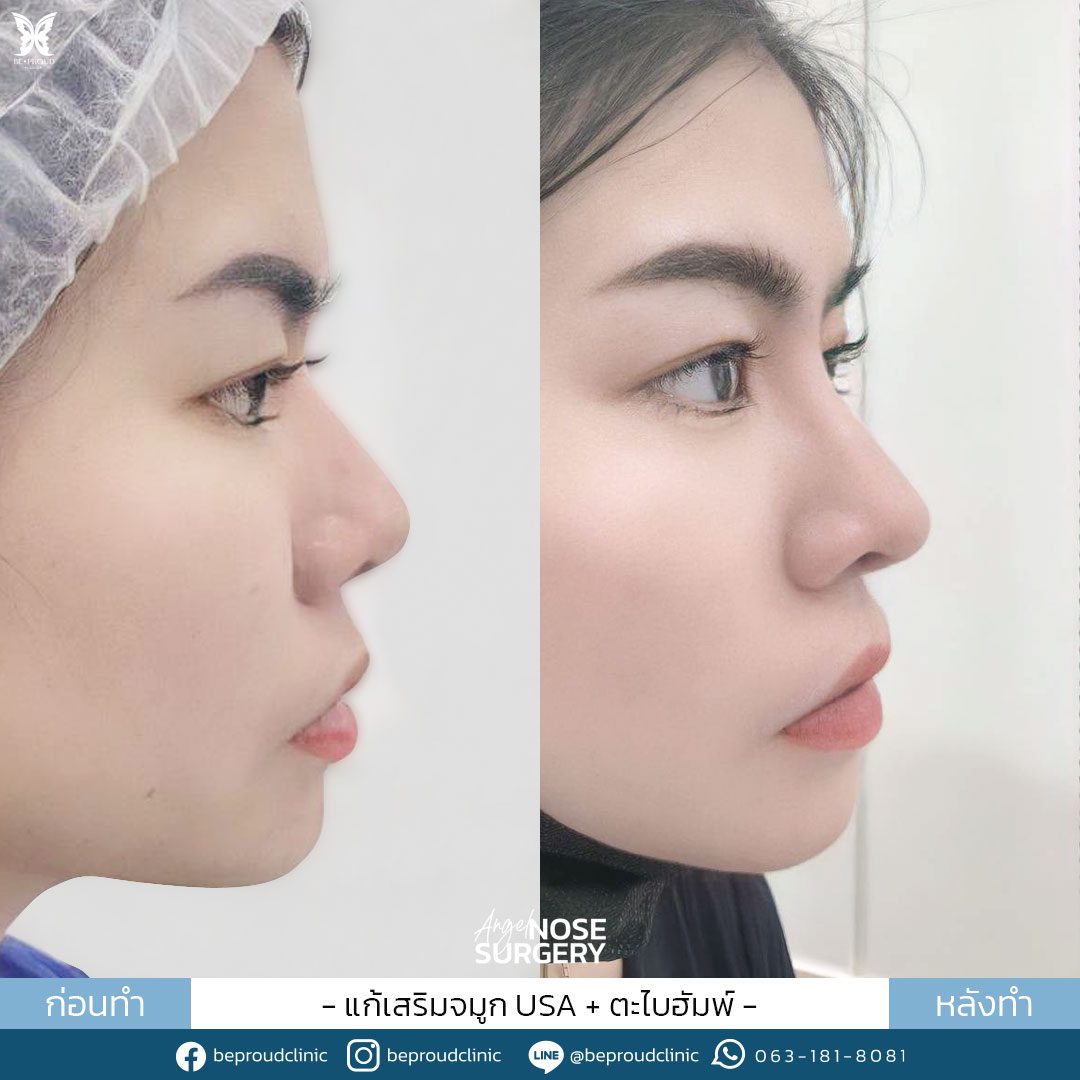 รีวิวจมูก-59 รีวิวจมูก-59
