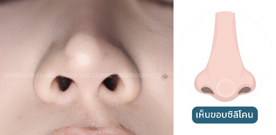 เห็นขอบซิลิโคน เห็นขอบซิลิโคน
