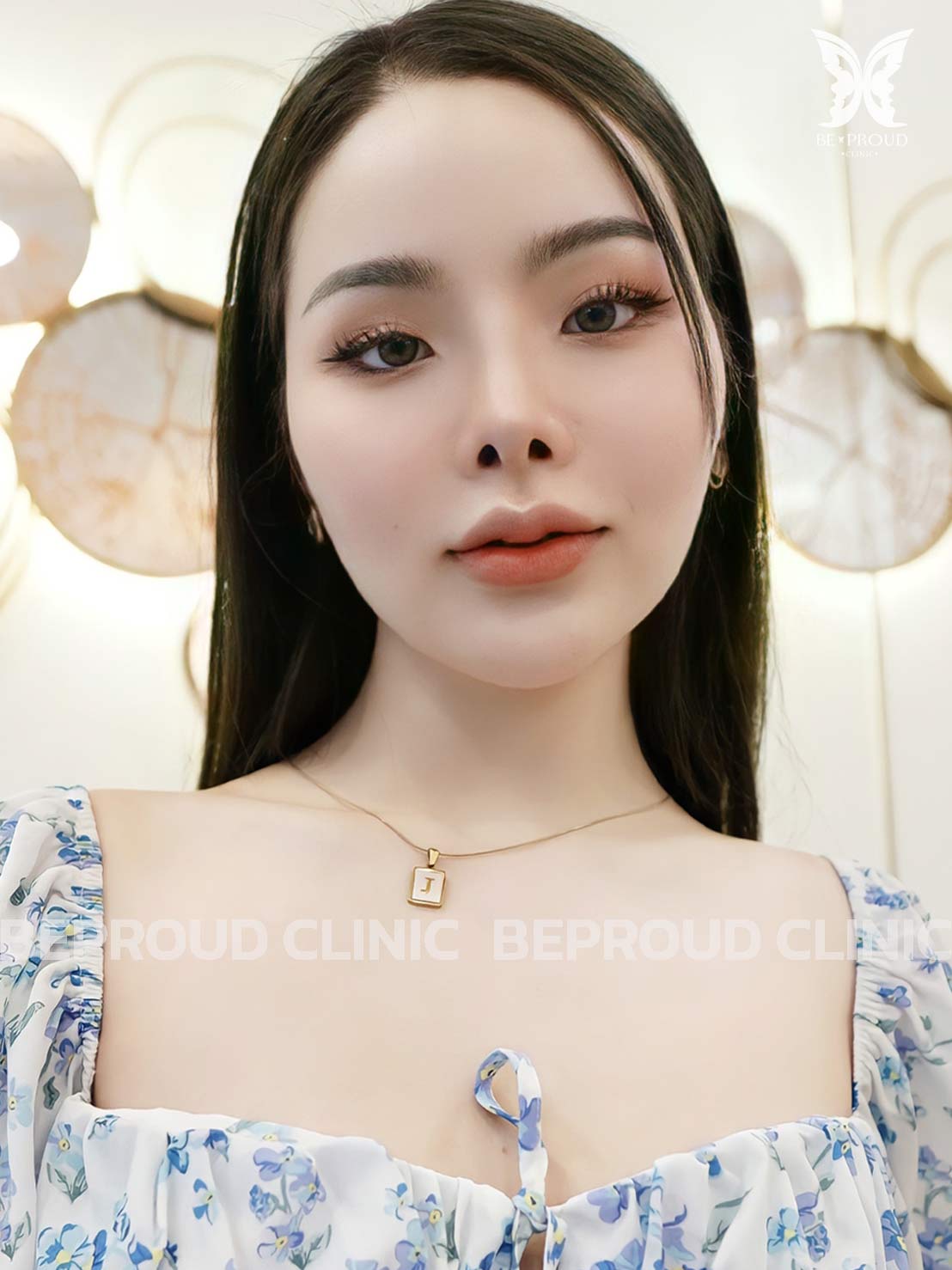 รึวิวฉีดฟิลเลอร์-6 รึวิวฉีดฟิลเลอร์-6