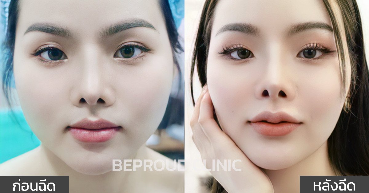 รีวิวก่อน-หลัง ฉีดฟิลเลอร์ รีวิวก่อน-หลัง ฉีดฟิลเลอร์