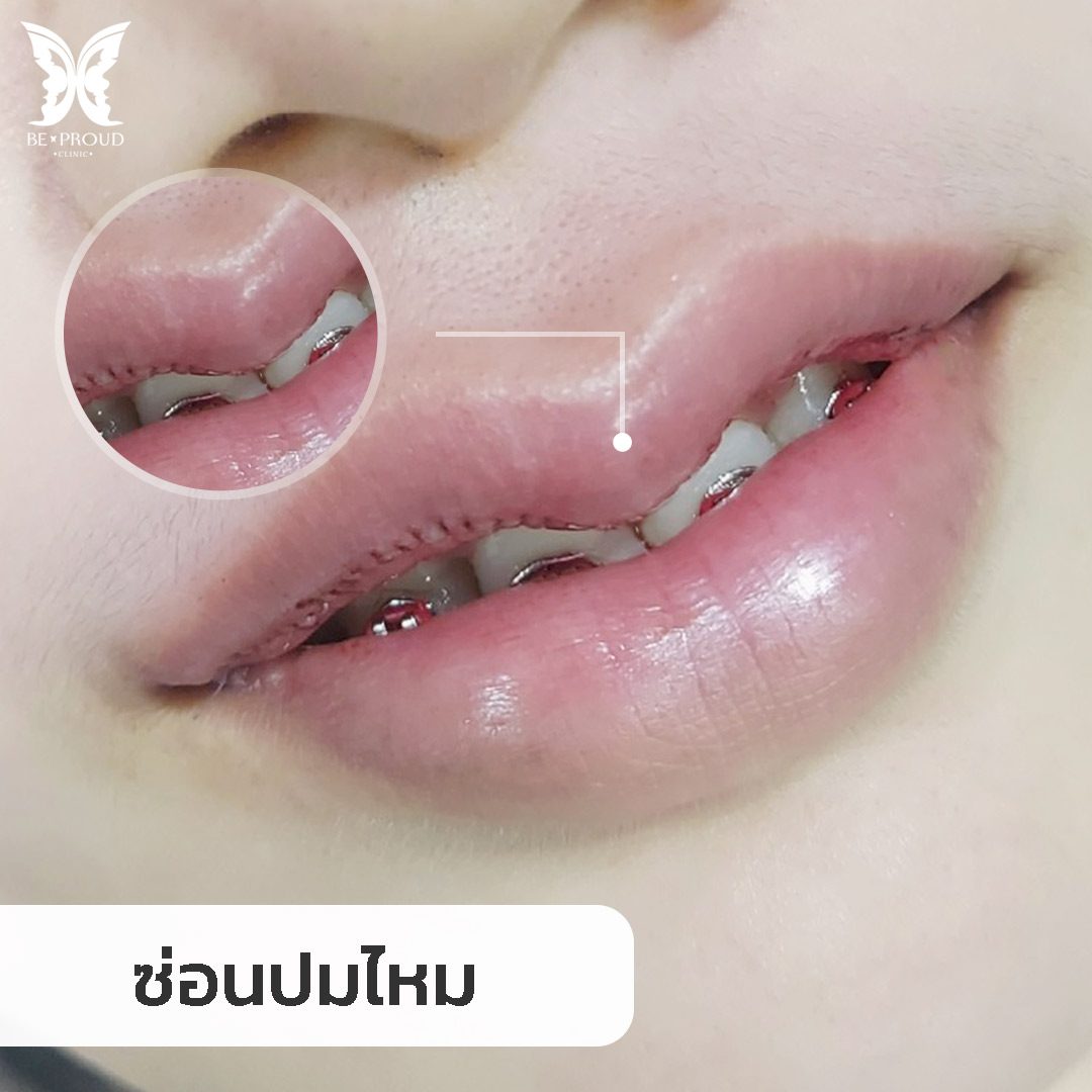 ซ่อนปมไหม ซ่อนปมไหม