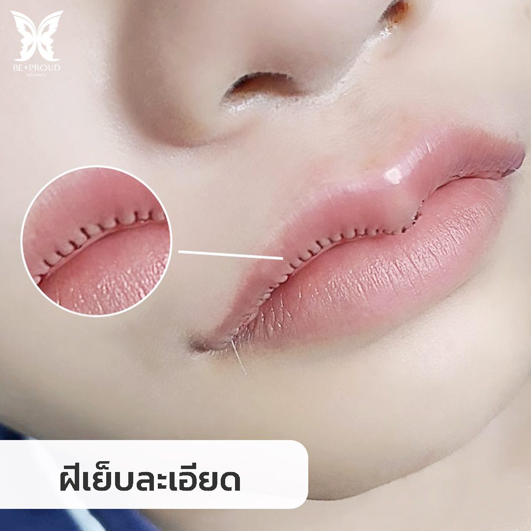 ฝีเย็บละเอียด ฝีเย็บละเอียด