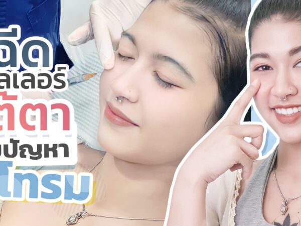 ฟิลเลอร์ใต้ตา