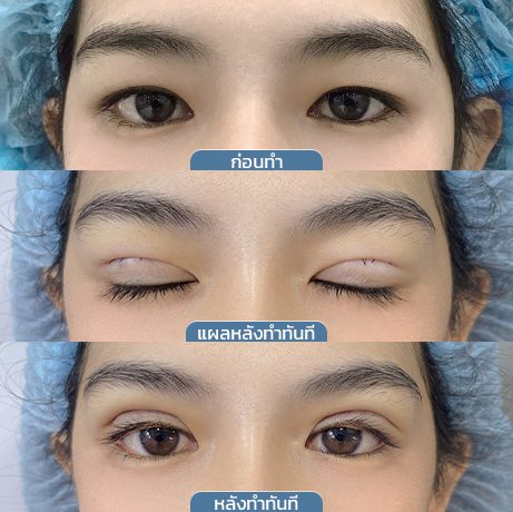 ก่อนหลัง_จุดเริ่มต้นกรีดแผลมินิ_3ช่อง3