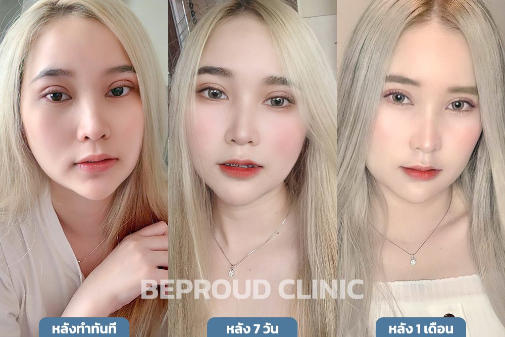 สายฝอvsสายเกา_เปรียบเทียบความบวม เปรียบเทียบความบวม