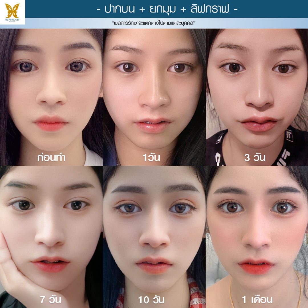 2 อัพเดท-ปากกระจับ