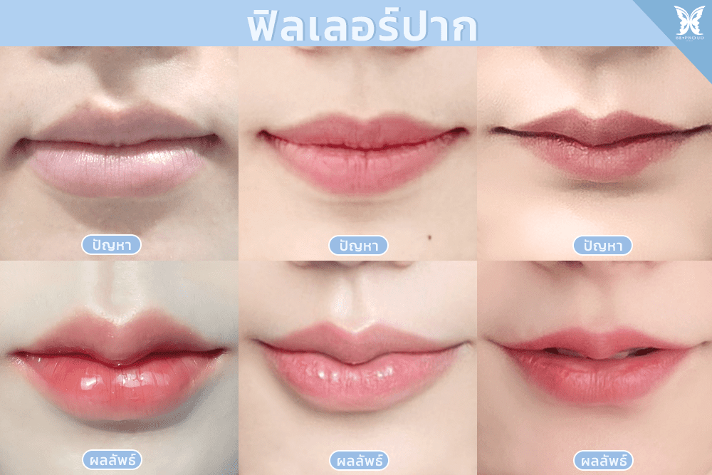 ฟิลเลอร์ปาก-1