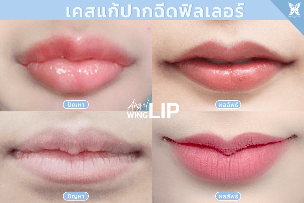 เคสแก้ปากฉีดฟิลเลอร์-ฉีดฟิลเลอร์ปากสามารถทำปากกระจับได้ไหม