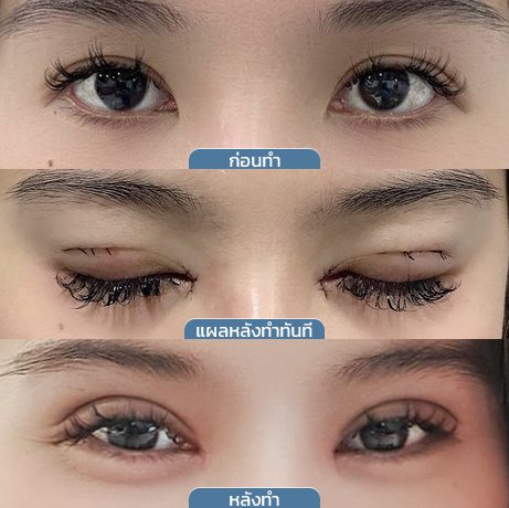 ก่อน_หลัง_แผลตาสองชั้น_2 ก่อน_หลัง_แผลตาสองชั้น_2