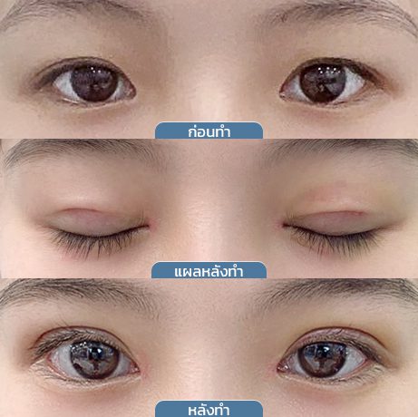 ก่อน_หลัง_แผลตาสองชั้น_3 ก่อน_หลัง_แผลตาสองชั้น_3