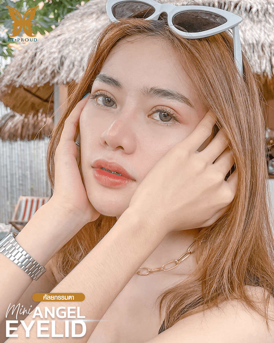 รีวิวตาสองชั้นกรีดยาวแผลมินิ-05