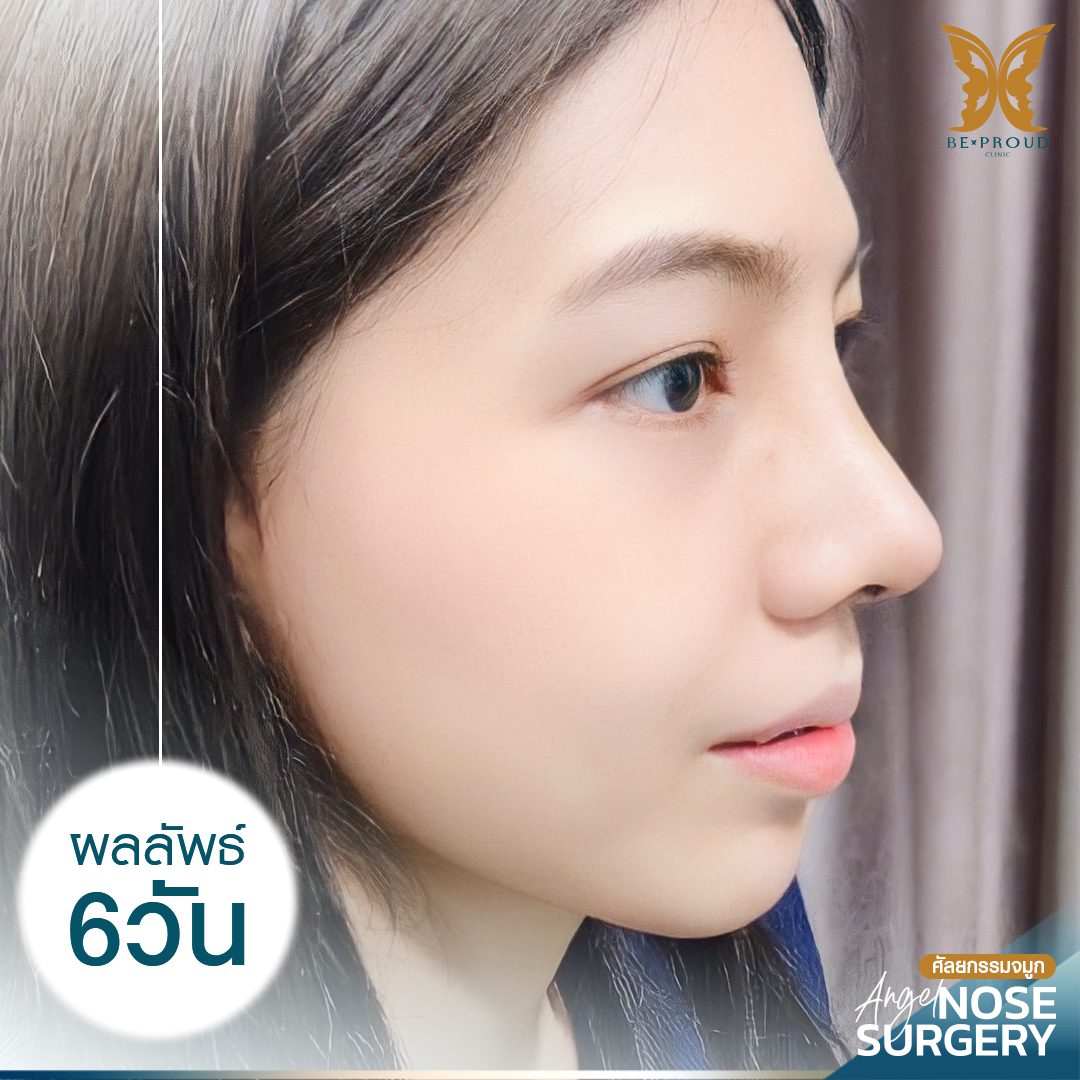 เสริมจมูกSlopeAngel-6-วัน-01 เสริมจมูกSlopeAngel-6-วัน-01