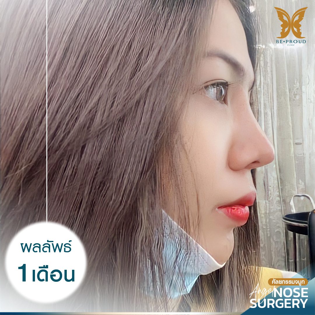 เสริมจมูกSlopeAngel-1-เดือน-02 เสริมจมูกSlopeAngel-1-เดือน-02