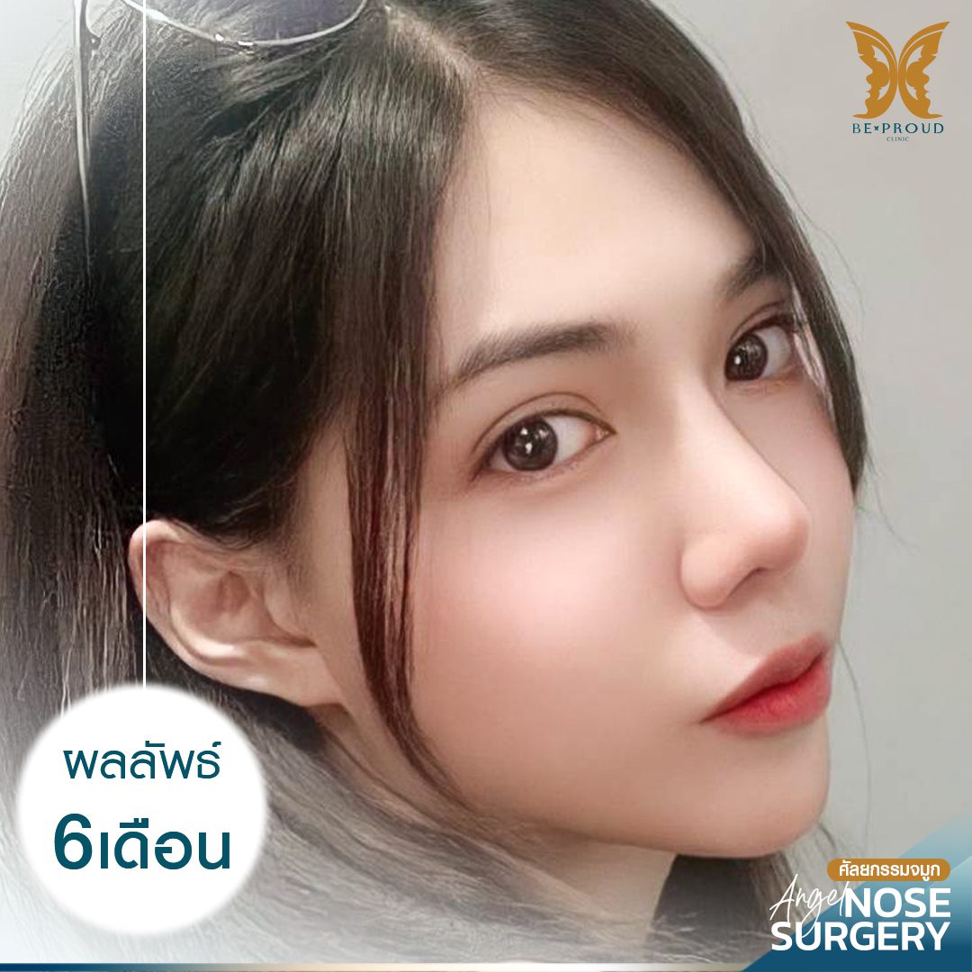 เสริมจมูกSlopeAngel-6-เดือน-03 เสริมจมูกSlopeAngel-6-เดือน-03
