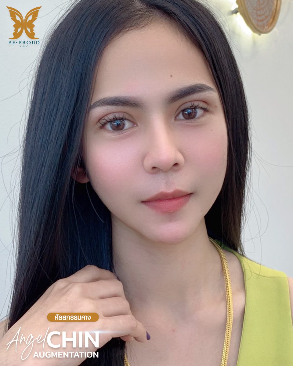 รีวิวเสริมคาง-08 รีวิวเสริมคาง-08
