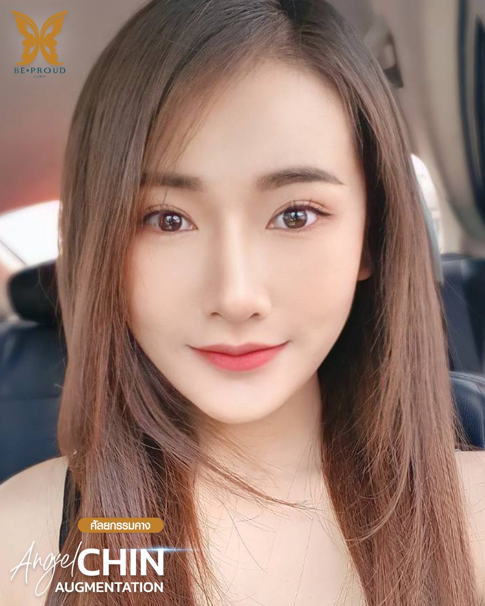 รีวิวเสริมคาง-05 รีวิวเสริมคาง-05
