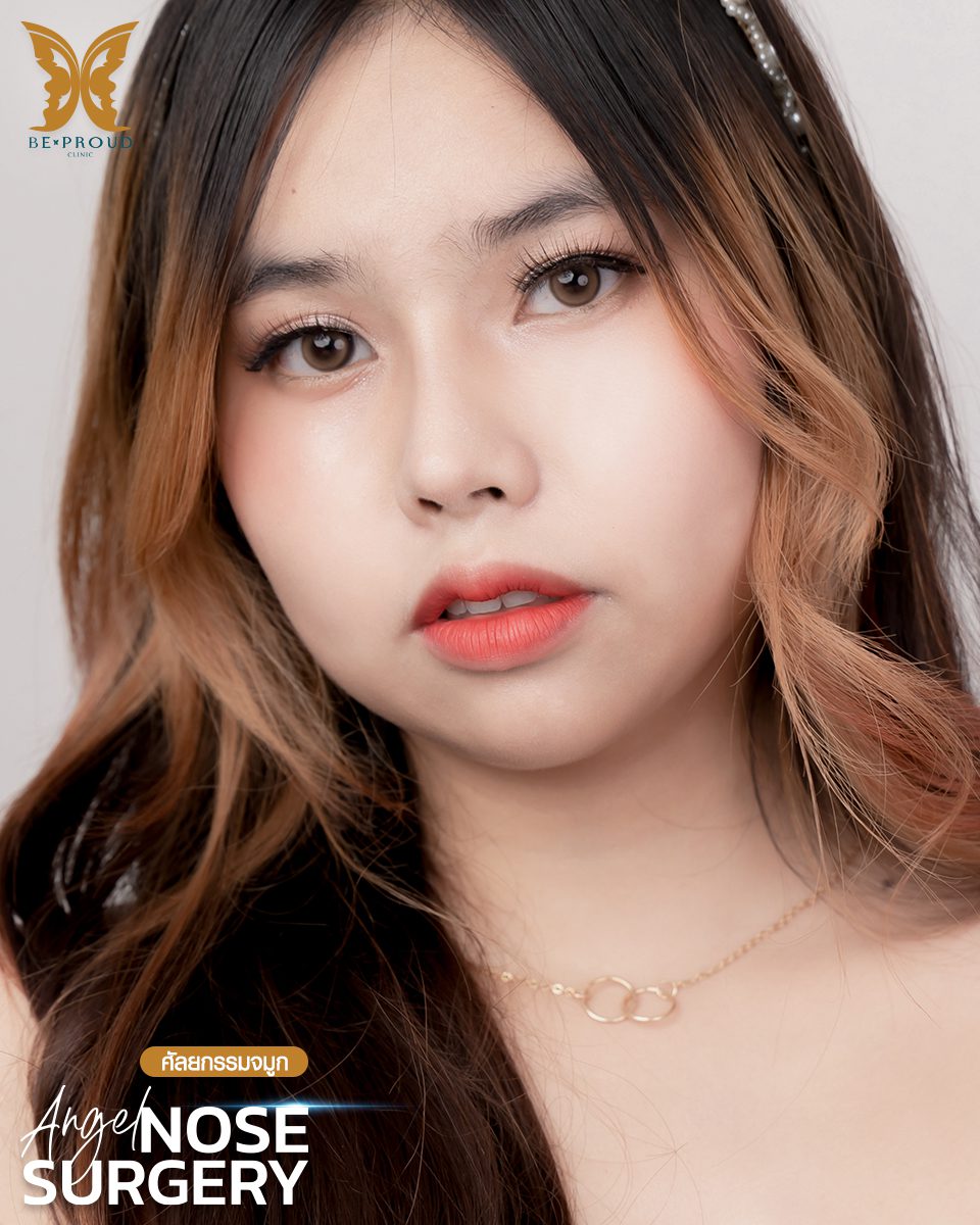 รีวิวเสริมจมูก-04 รีวิวเสริมจมูก-04