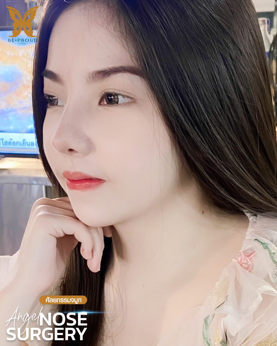 รีวิวเสริมจมูก-07 รีวิวเสริมจมูก-07