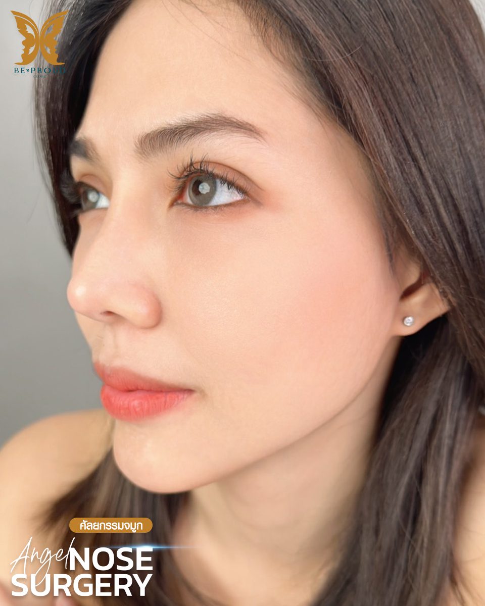 รีวิวเสริมจมูก-03 รีวิวเสริมจมูก-03
