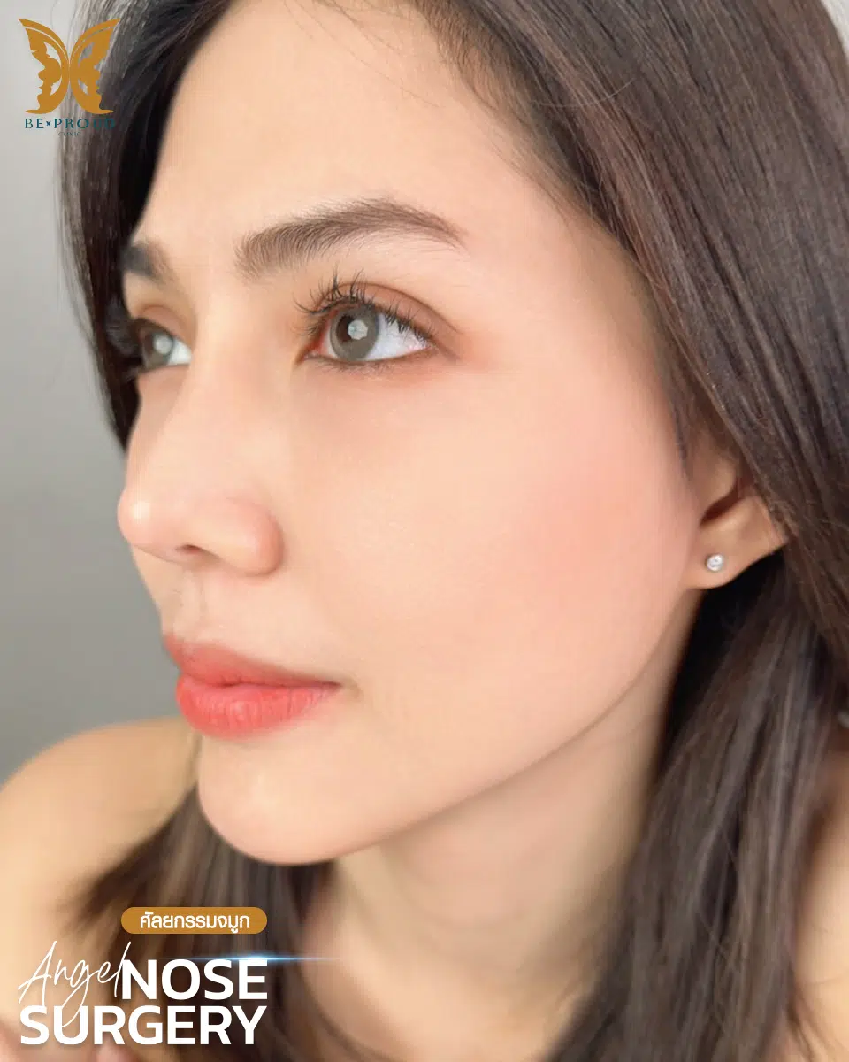 รีวิวเสริมจมูก-03