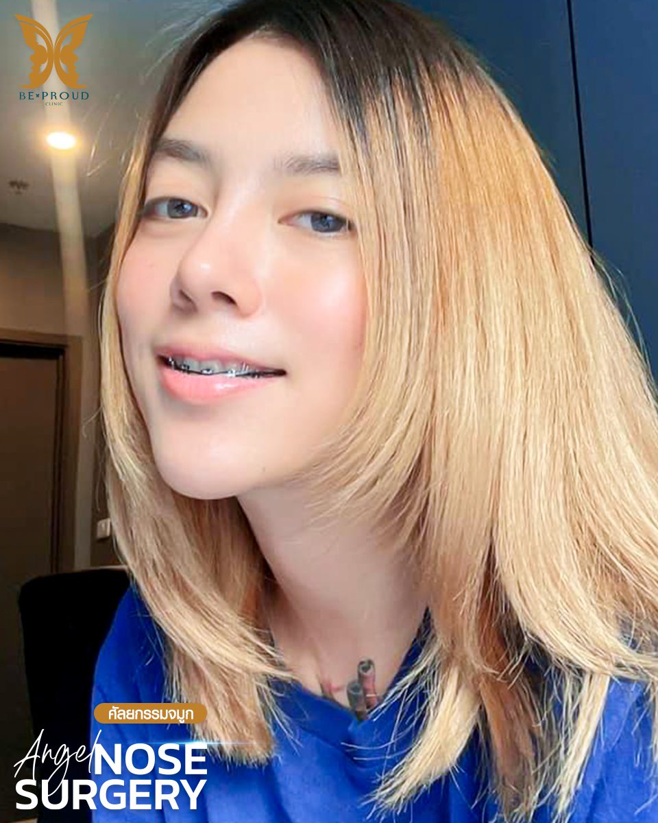 รีวิวเสริมจมูก-09 รีวิวเสริมจมูก-09