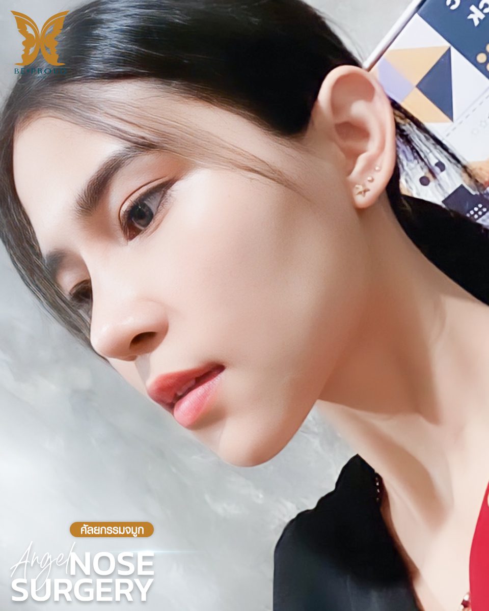 รีวิวเสริมจมูก-08 รีวิวเสริมจมูก-08