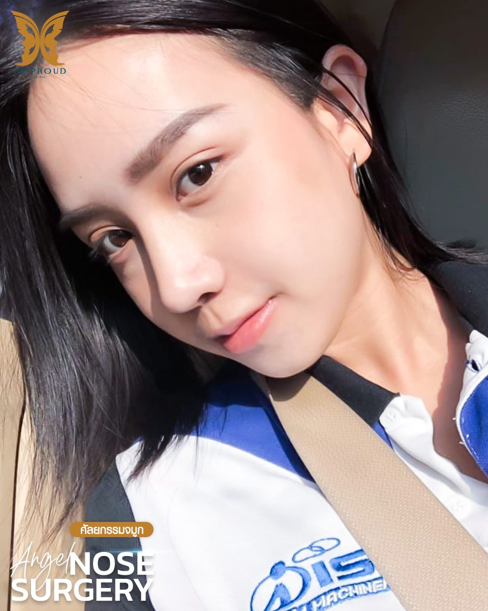 รีวิวเสริมจมูก-06 รีวิวเสริมจมูก-06
