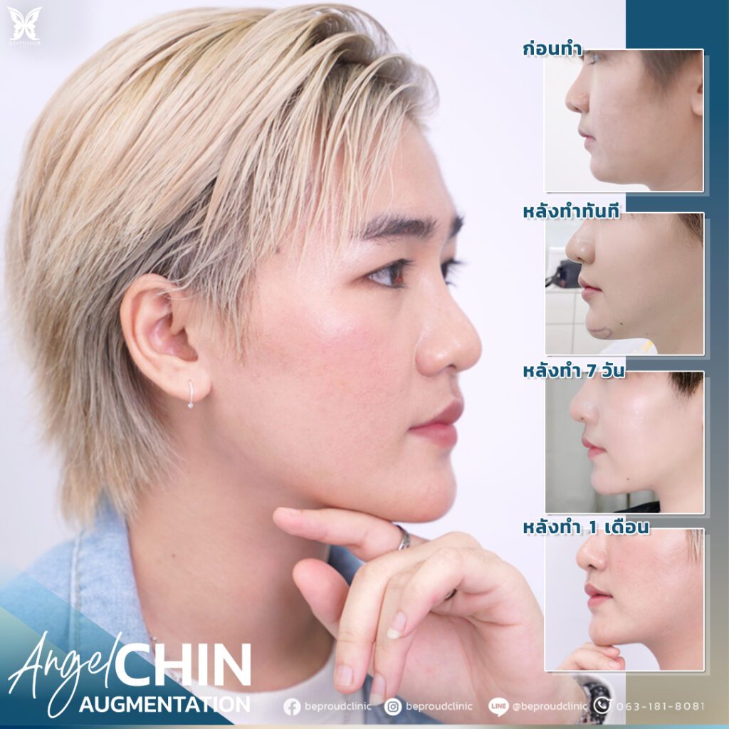 เสริมคาง-01 เสริมคาง-01