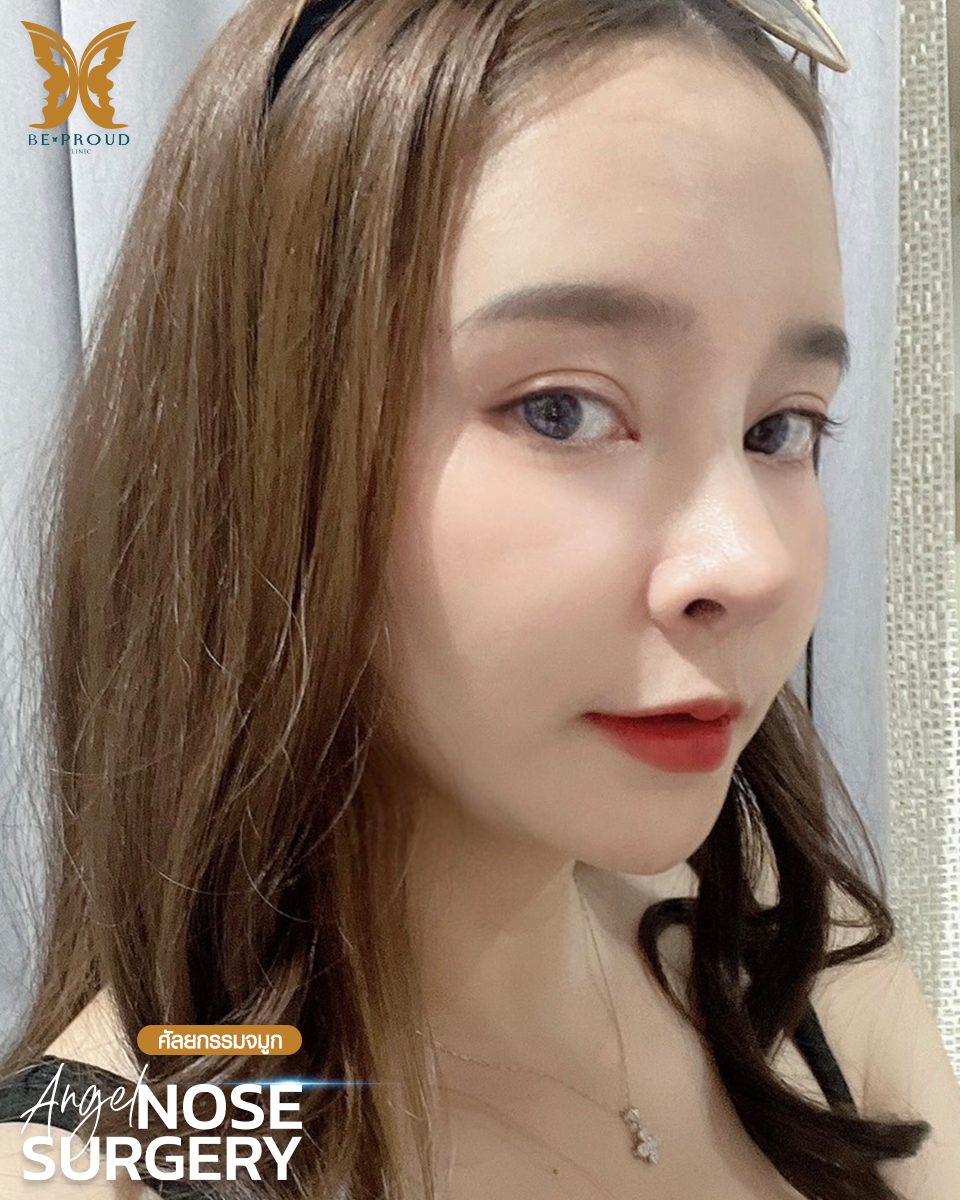 รีวิวเสริมจมูก(1) รีวิวเสริมจมูก(1)