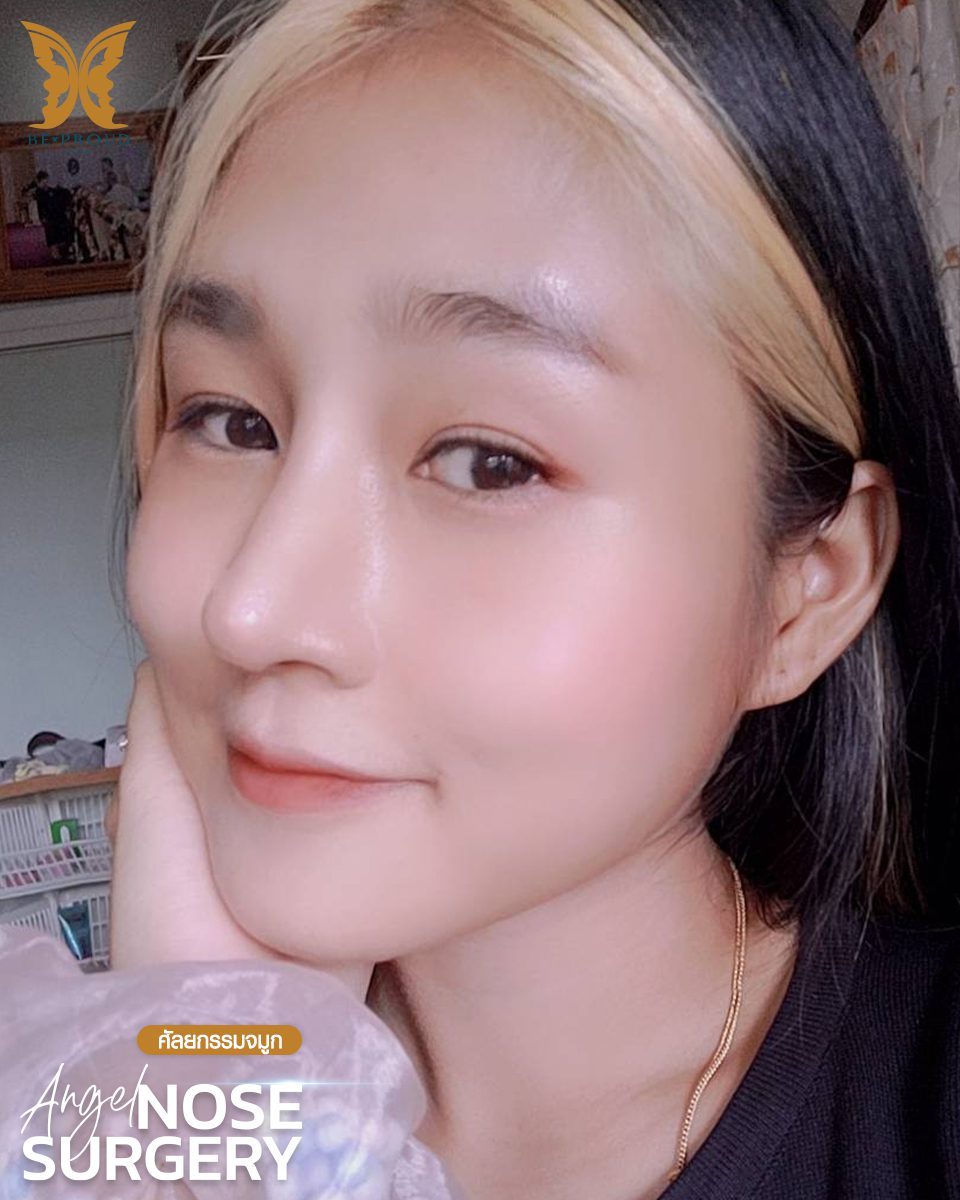 รีวิวเสริมจมูก(3) รีวิวเสริมจมูก(3)
