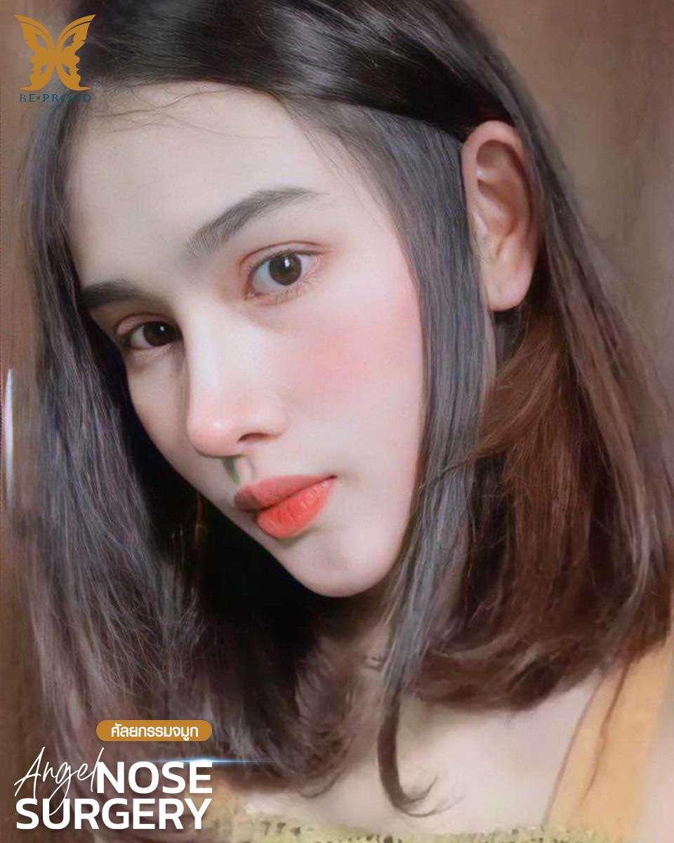 รีวิวเสริมจมูก(4) รีวิวเสริมจมูก(4)