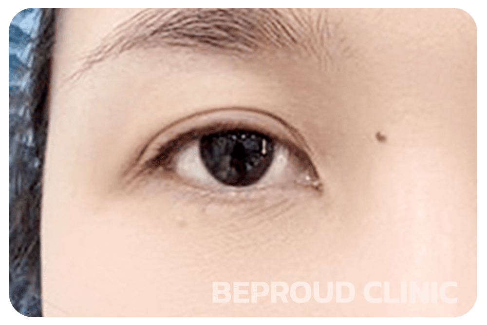 ตาสองชั้นหลบใน หางตาตก