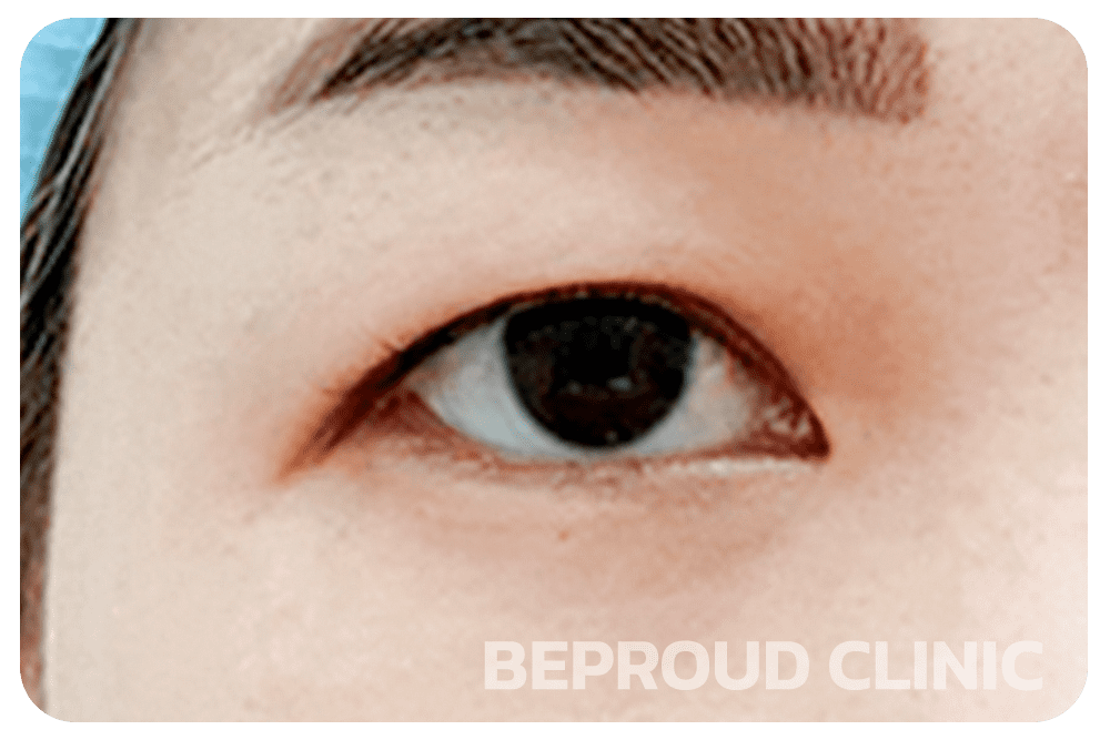 ไขมันที่เปลือกตาเยอะ