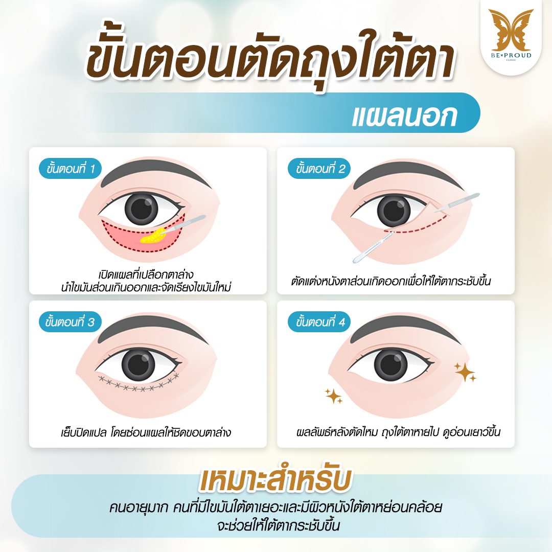 ถุงใต้ตา