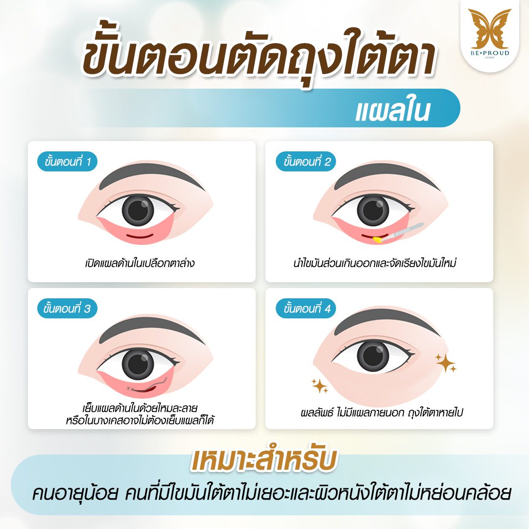 ถุงใต้ตา