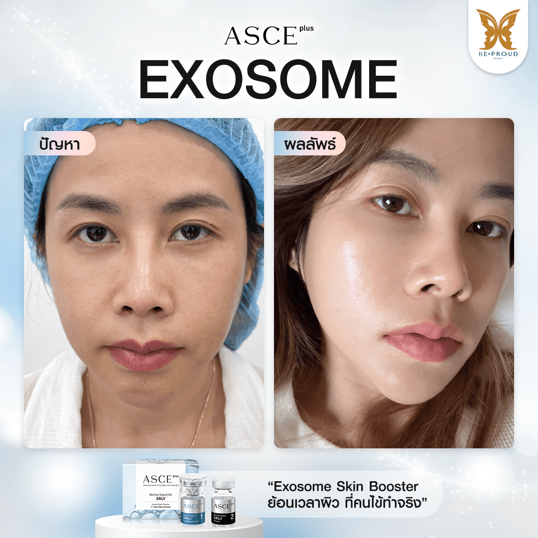 ฉีด Exosome ดีไหม ฉีด Exosome ดีไหม