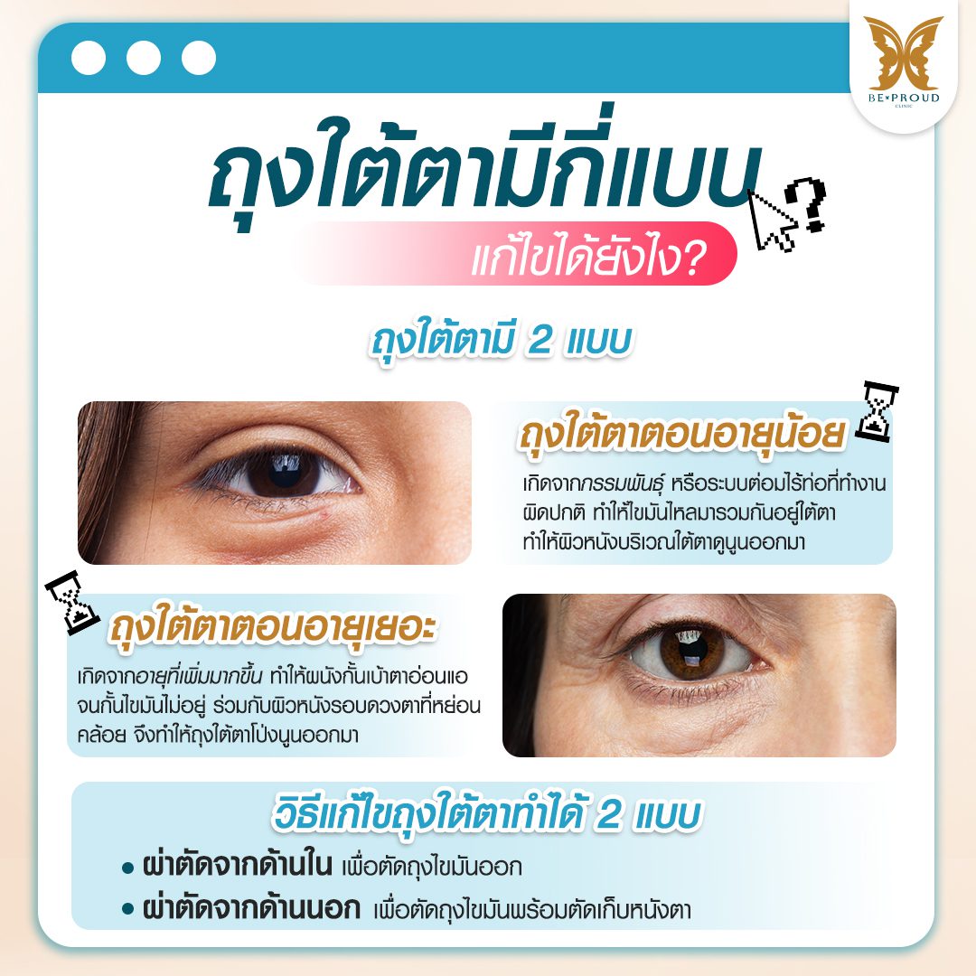 ถุงใต้ตามีกี่แบบ ถุงใต้ตามีกี่แบบ