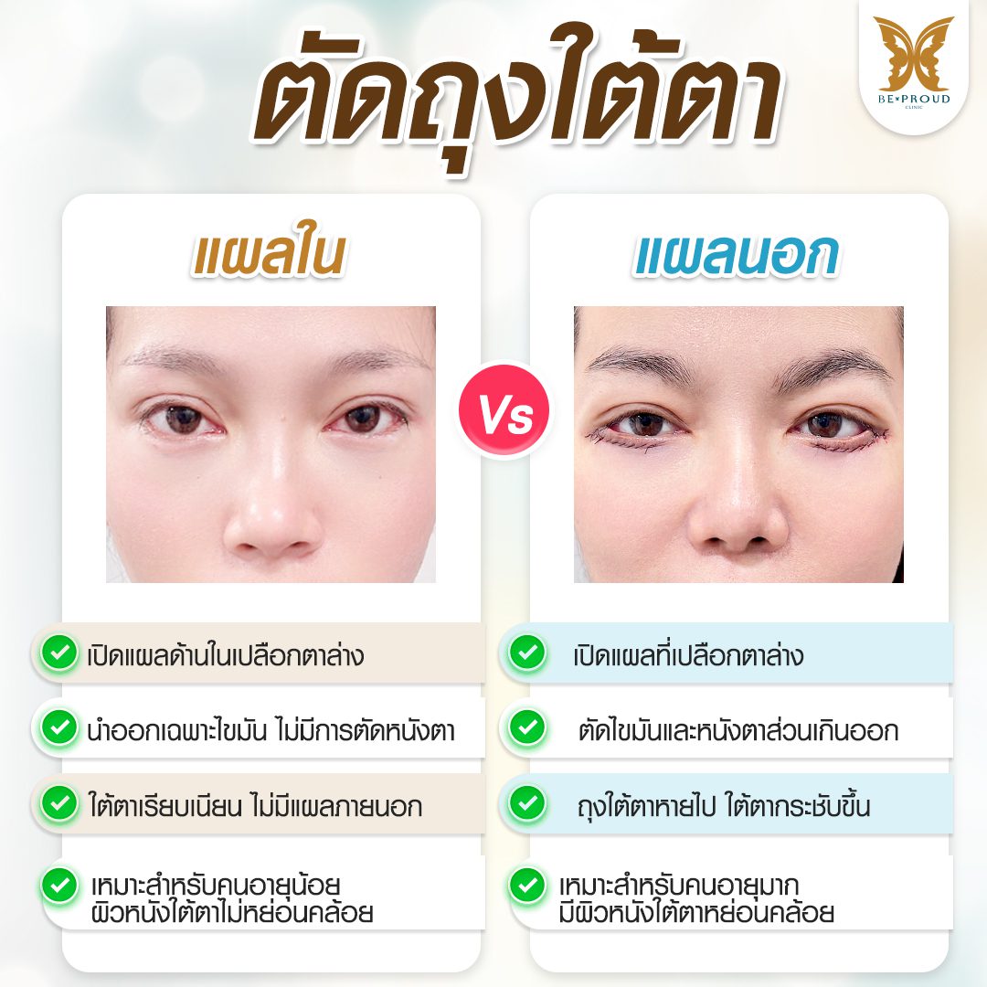 ตัดถุงใต้ตา ตัดถุงใต้ตา