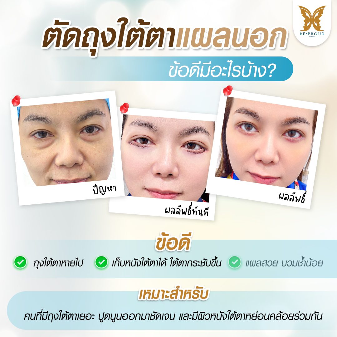 ถุงใต้ตาแผลนอก ถุงใต้ตา ถุงใต้ตา