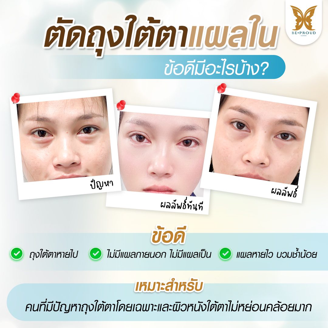 ถุงใต้ตาแผลใน ถุงใต้ตา