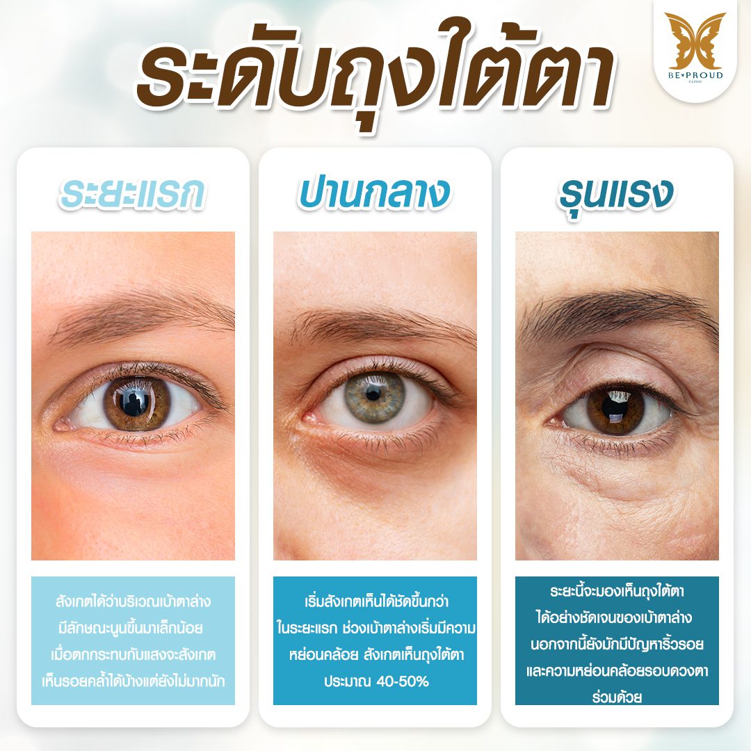 เช็ดระดับถุงใต้ตา ถุงใต้ตา เช็ดระดับถุงใต้ตา ถุงใต้ตา