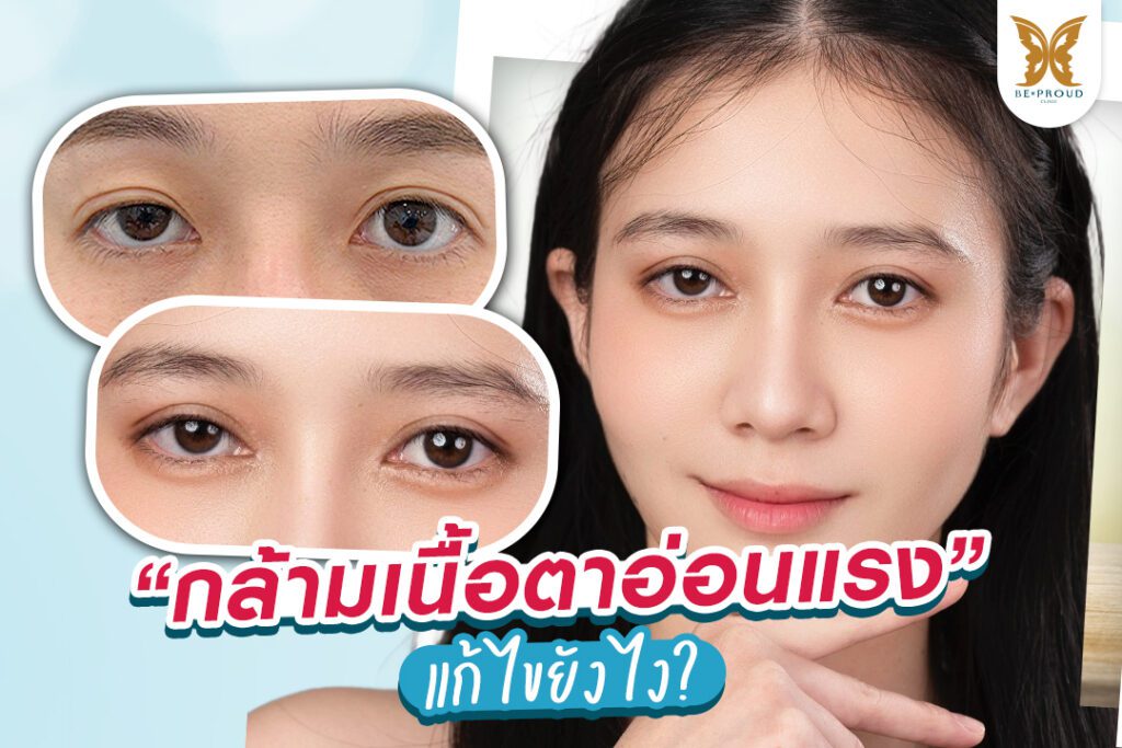 เป็นกล้ามเนื้อตาอ่อนแรง แก้ไขยังไง?