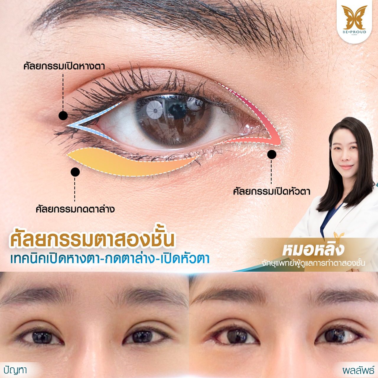 เทคนิคการเปิดหางตา เทคนิคการเปิดหางตา